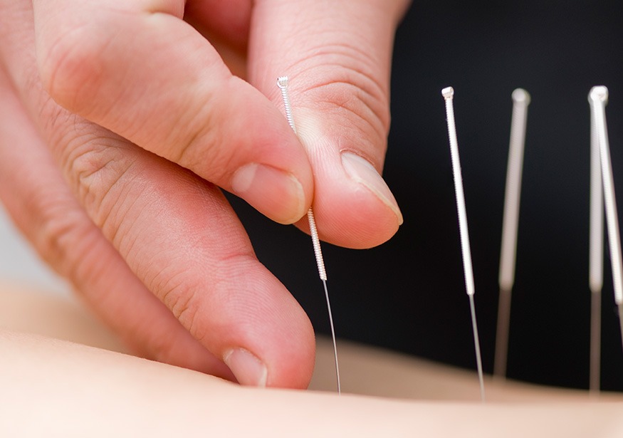 Acupuncture | Complete Health | Chiropractic & Wellness Clinic | Okotoks & SW Calgary